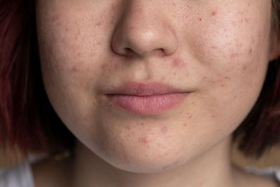 How To Get Rid Of Acne And Teen Spots In 3 Simple Procedures