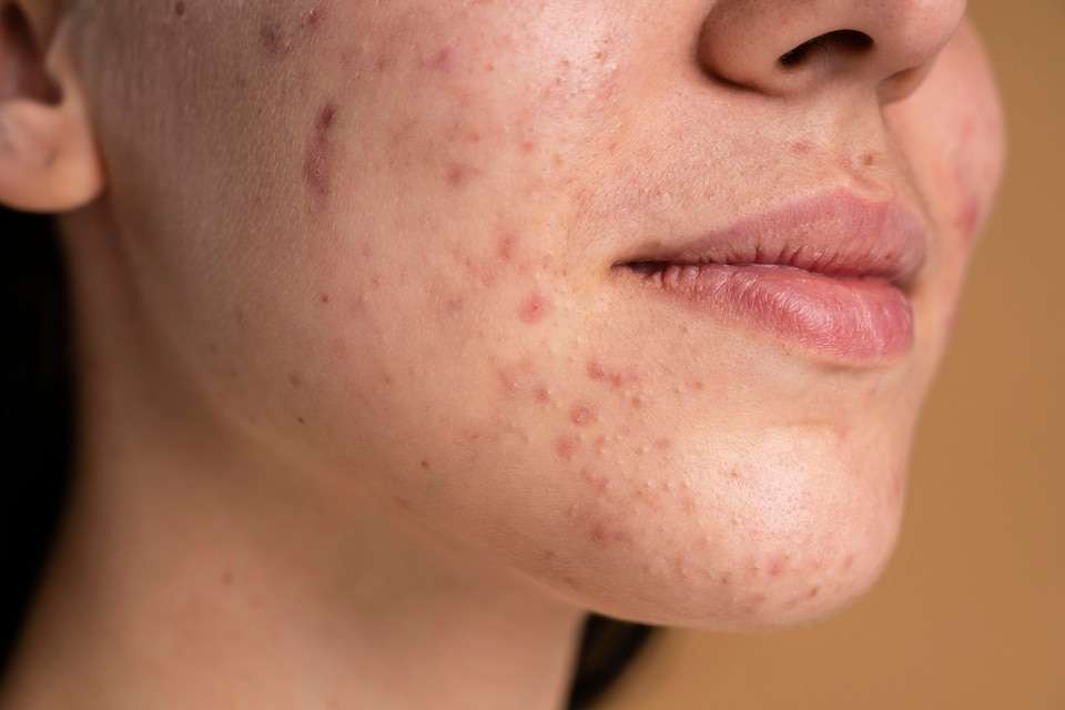 How To Face Beat Acne And Breakouts