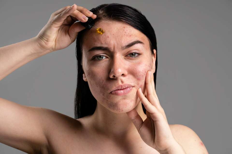 7 Telltale Signs You Have Hormonal Acne