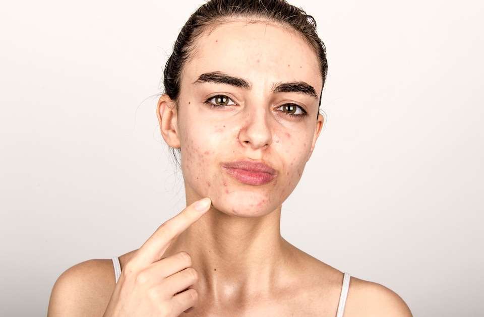 What You Require To Know About Acne Skin Facts 2023