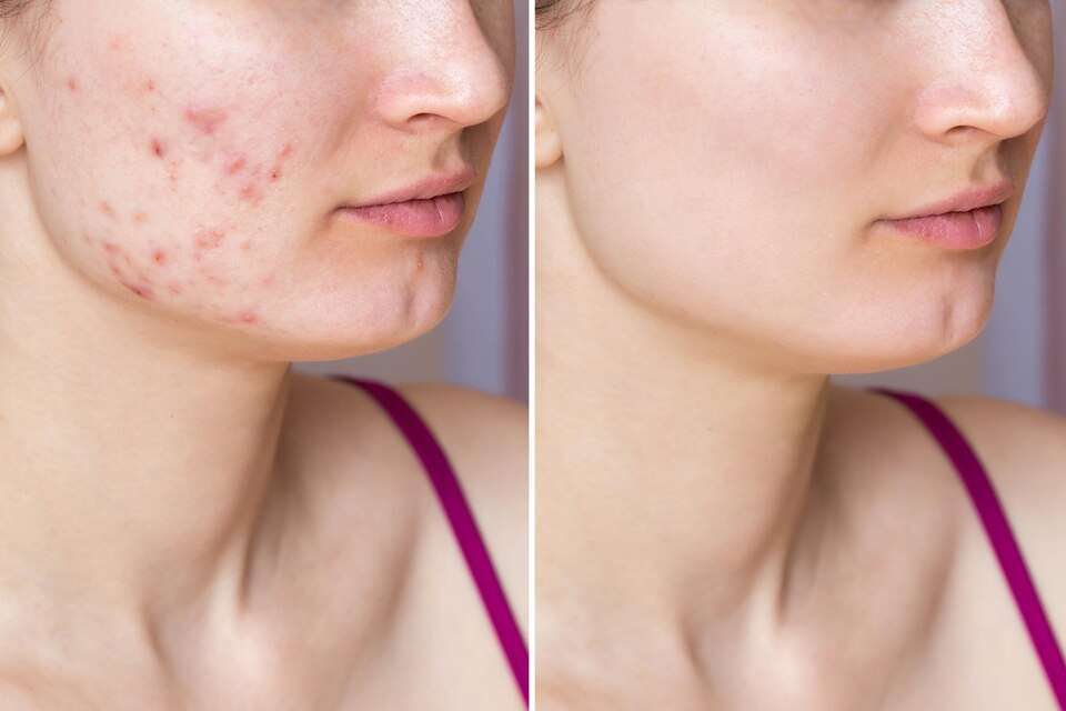 Is It Possible That Salicylic Acid Could Help Remove Acne Scars?