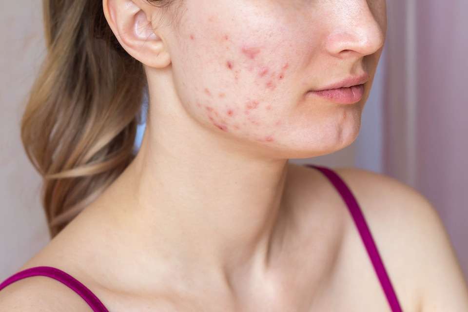 How To Tell The Distinction Between Acne Scars And Acne Marks