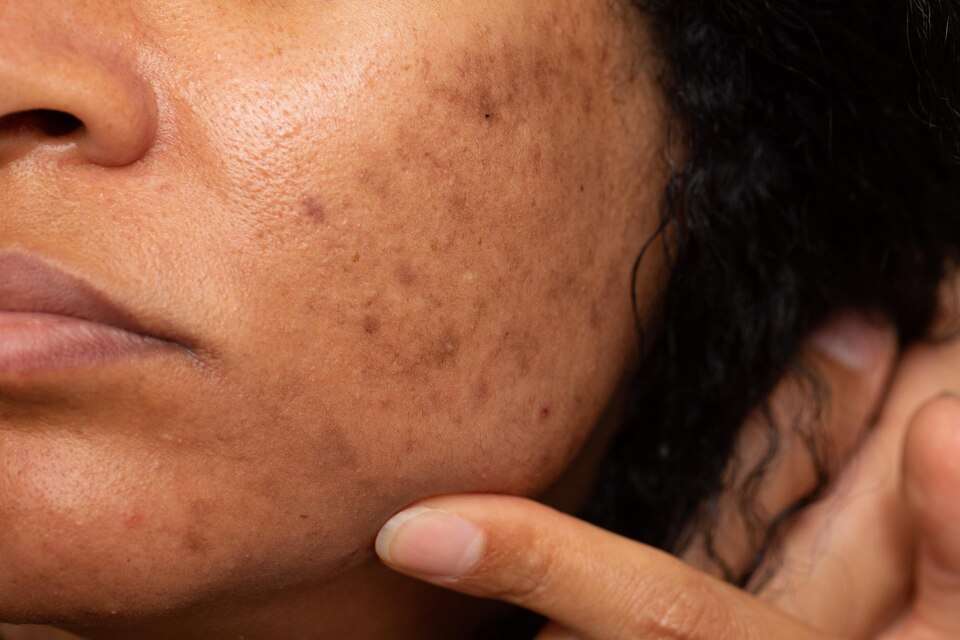 How Can I Remove Acne Scars That Are Very Deep-Pitted?