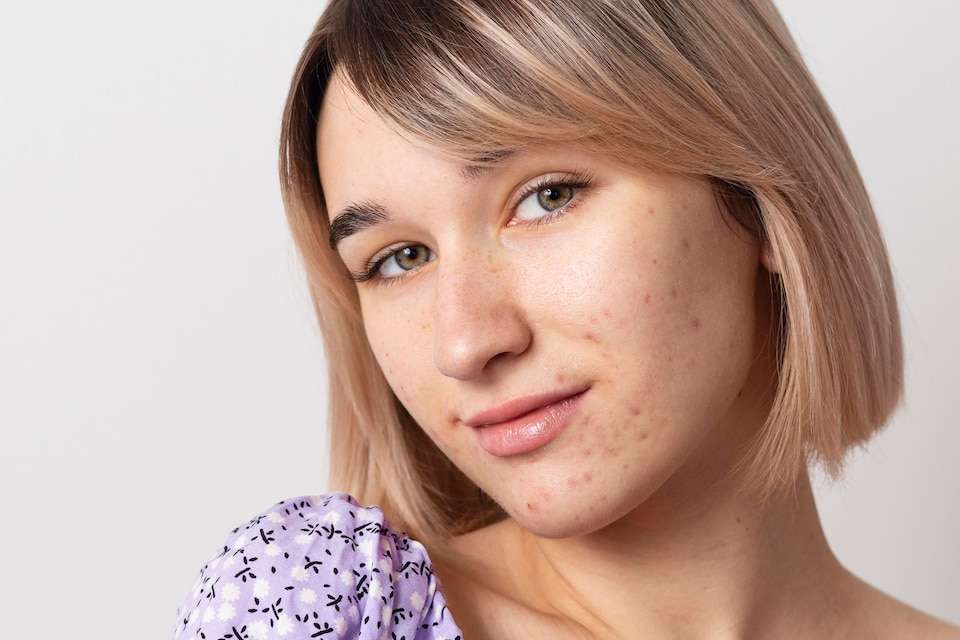 Tips For The Acne Treatment In Teenagers